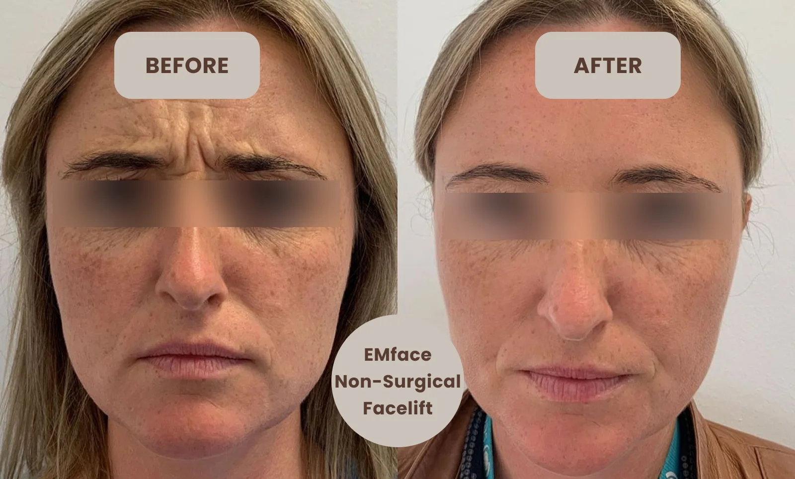 cost of emface treatment