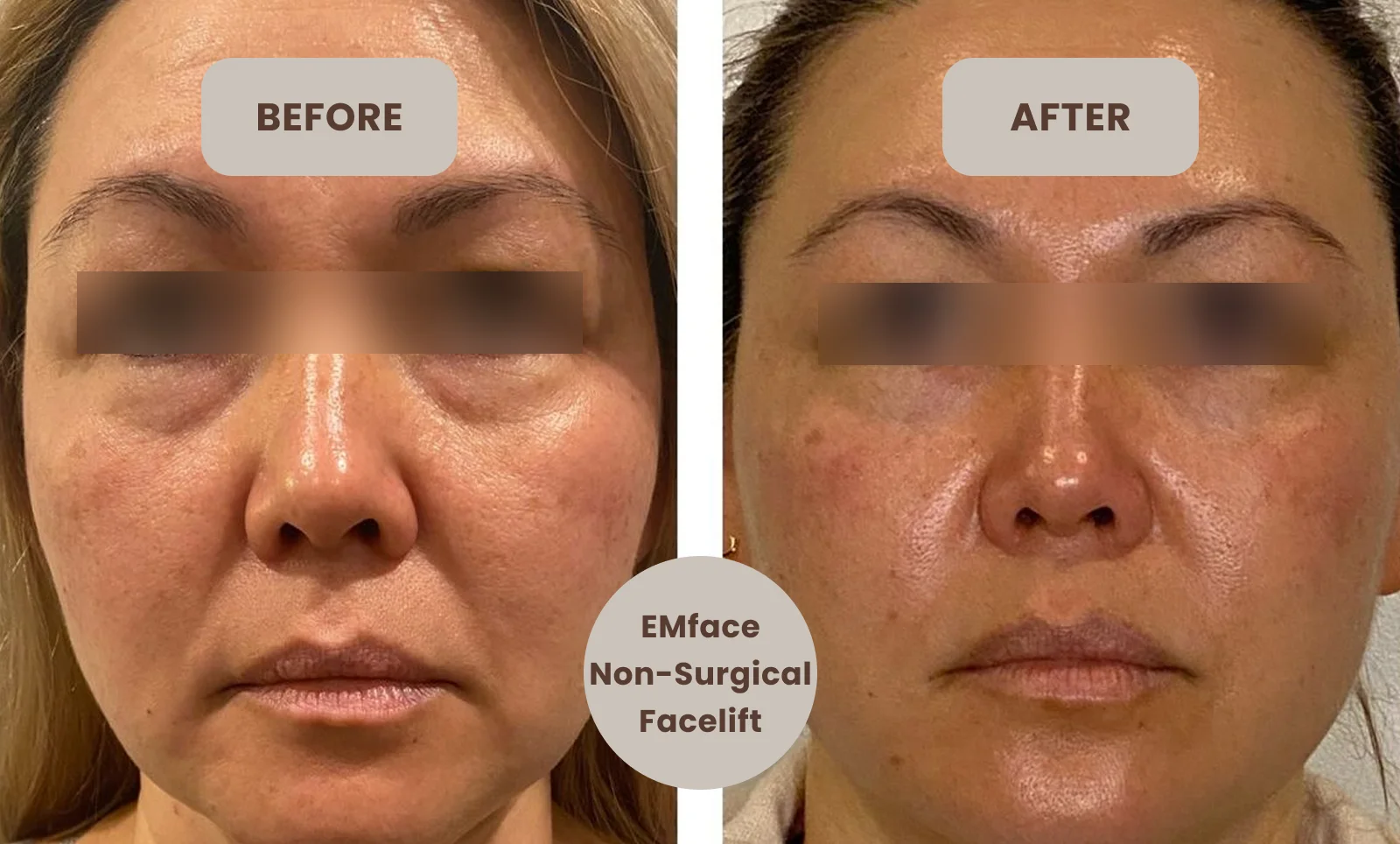 emface treatment birmingham