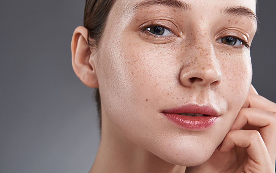 Hyperpigmentation