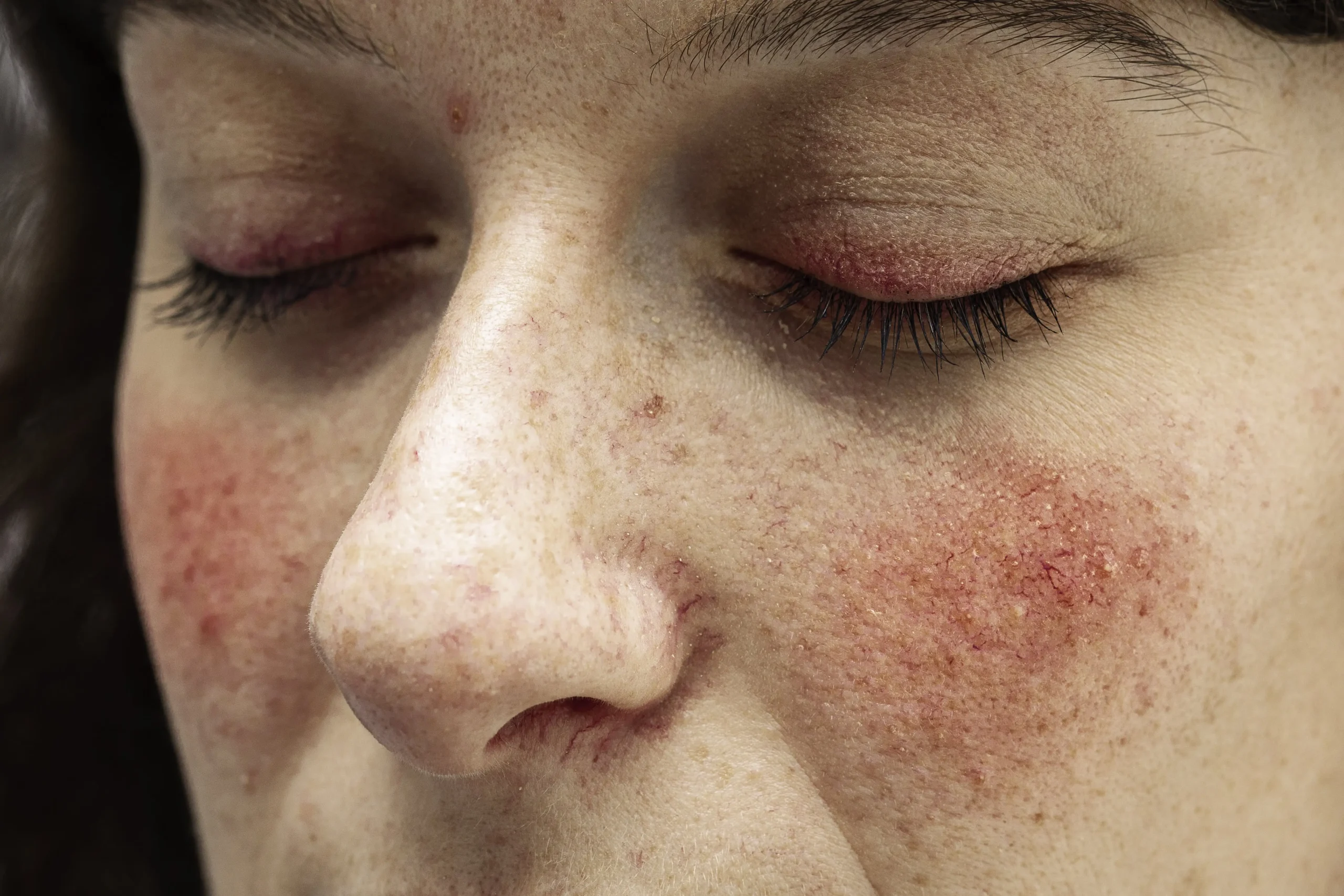 Rosacea 