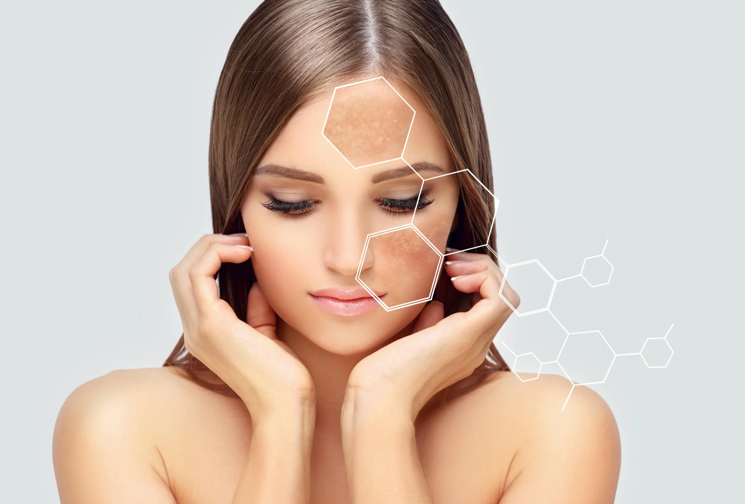 Melasma