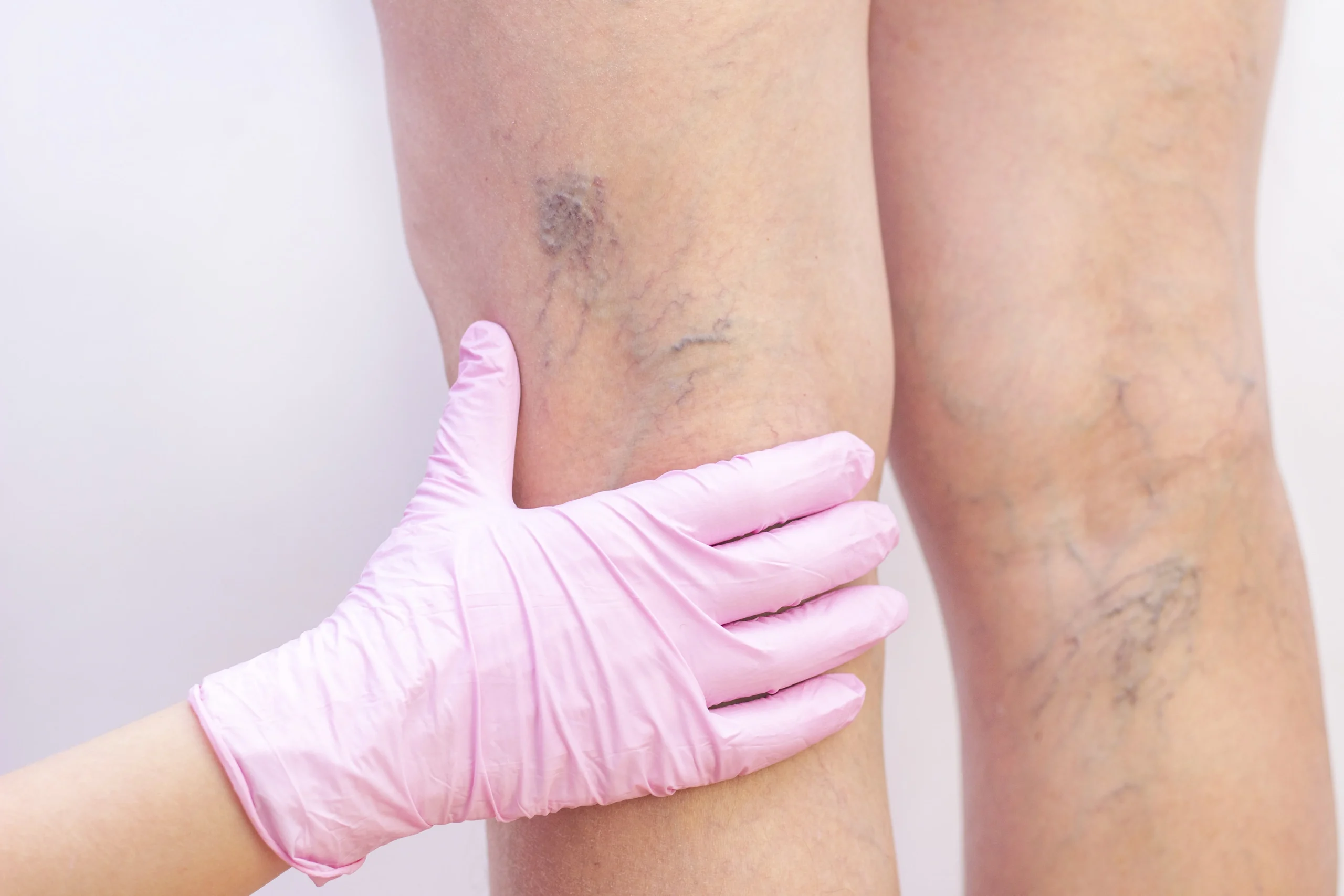 Telangiectasia or Broken Veins