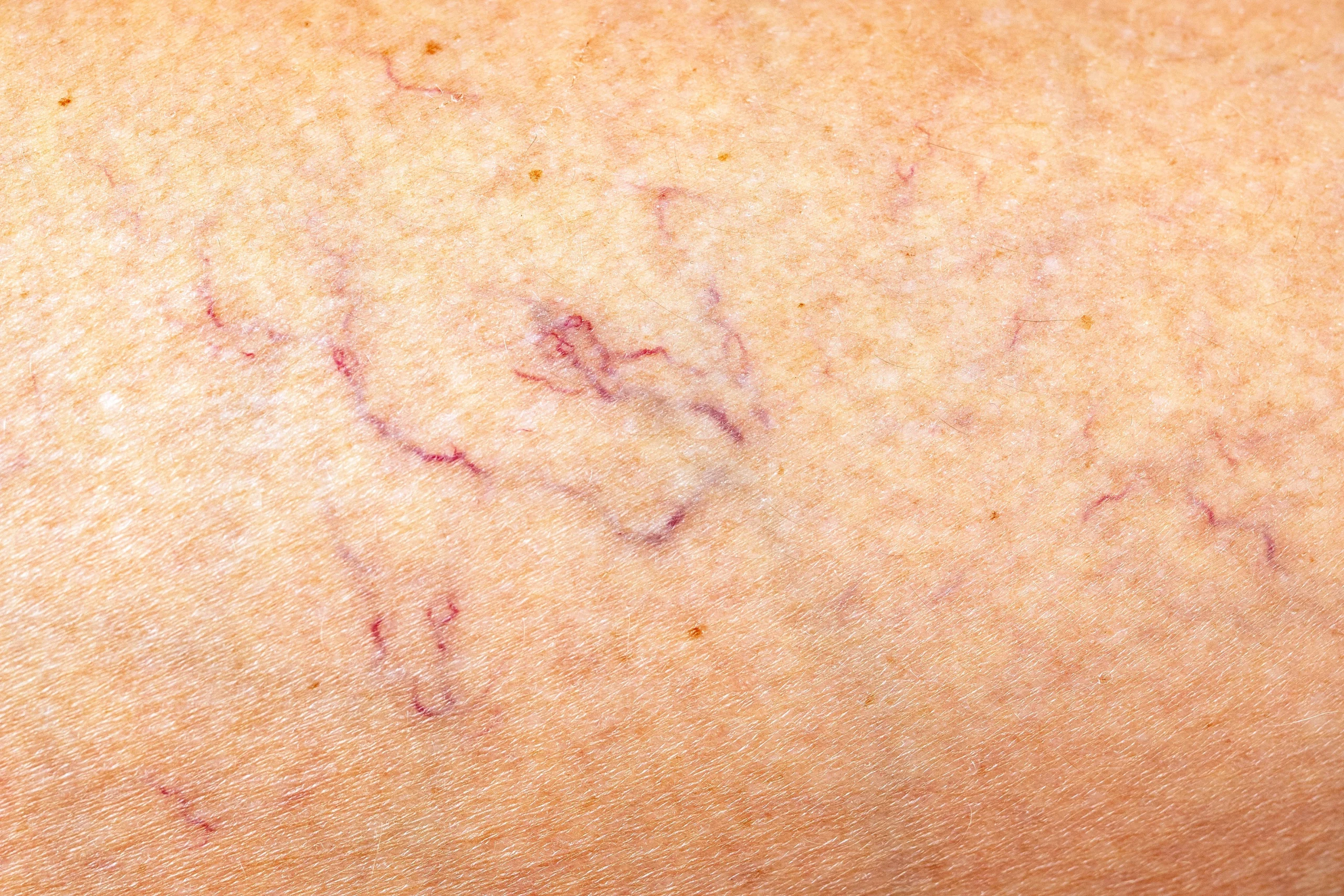 Thread Vein