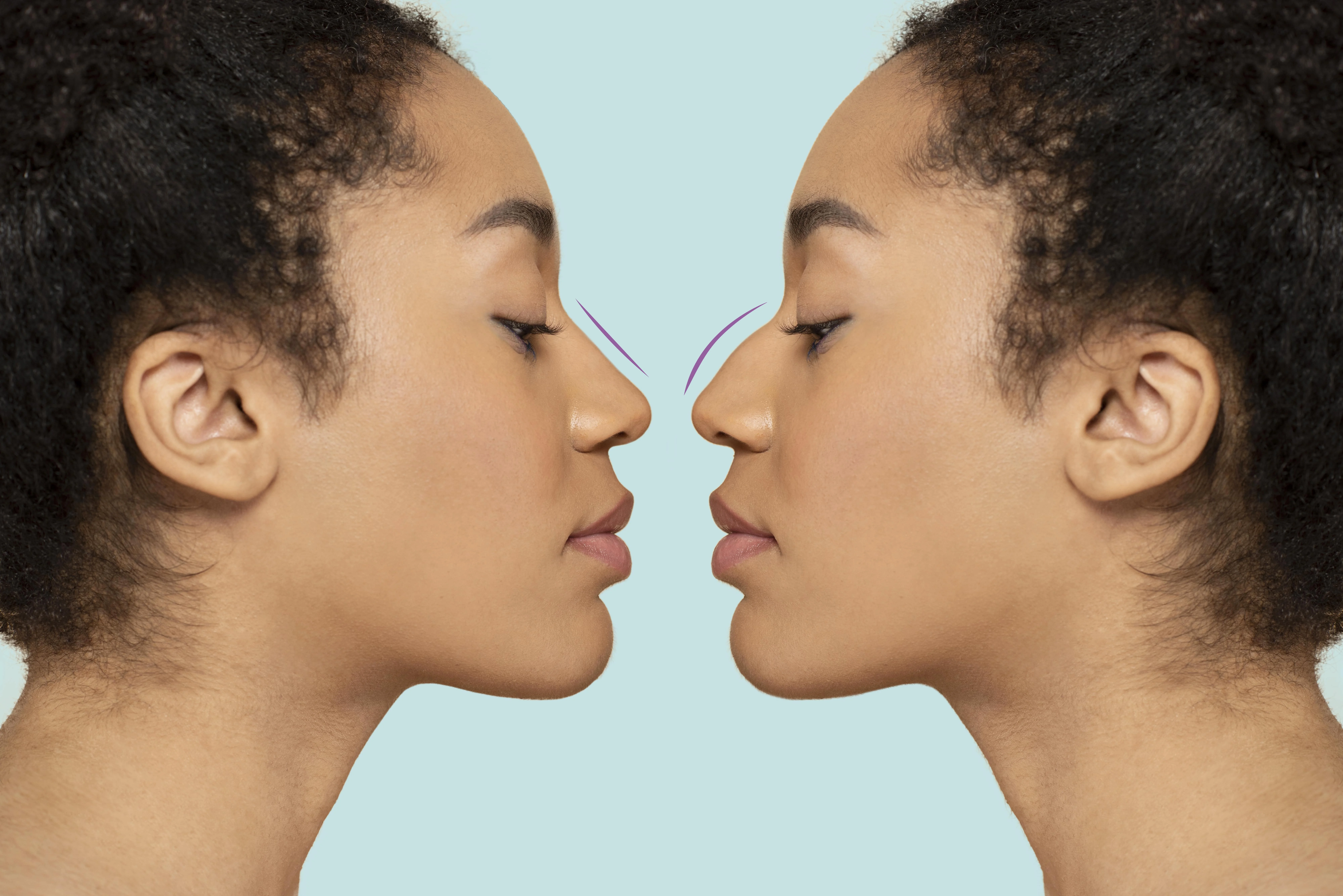 Hooked Nose/Bump