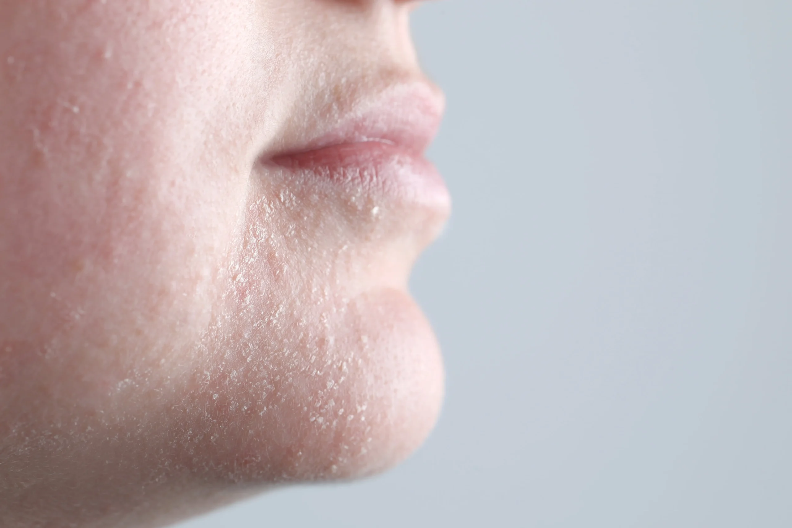 Dry Skin