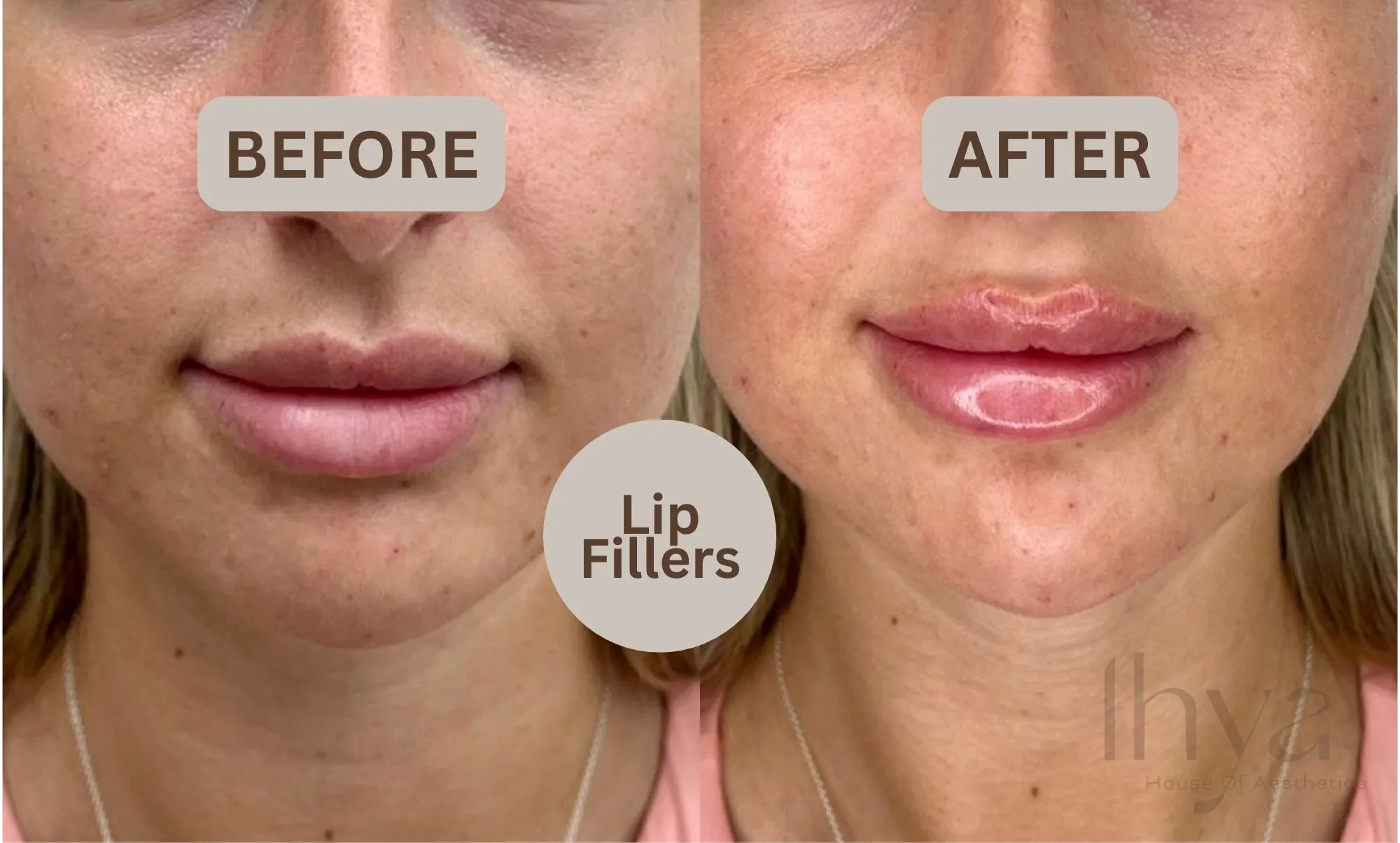lip fillers treatment