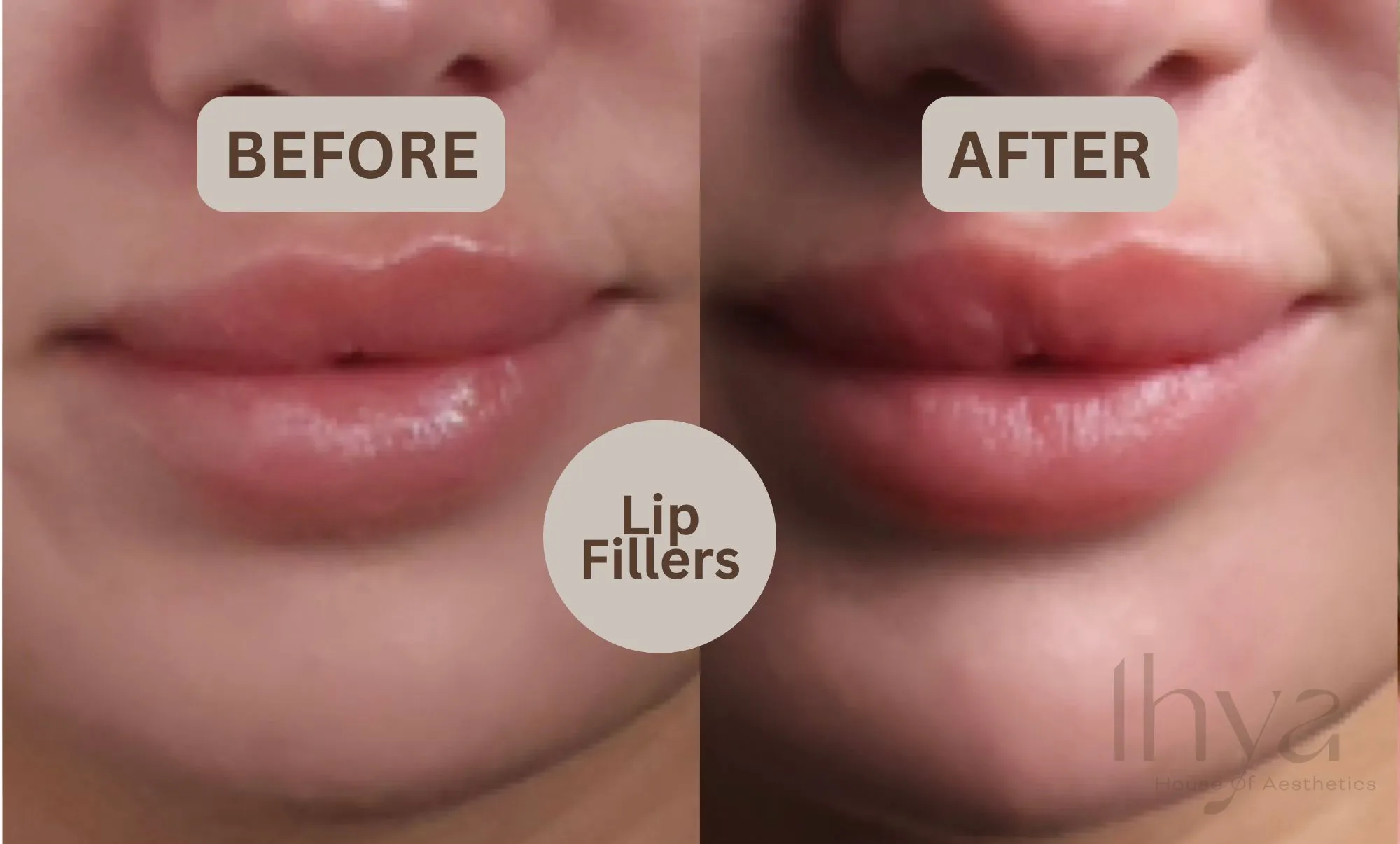 lip fillers in Birmingham