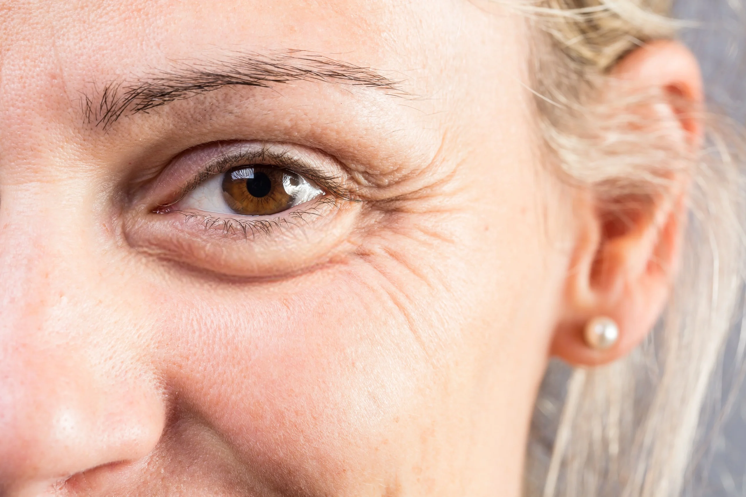 Drooping eyelids (Brow lift)
