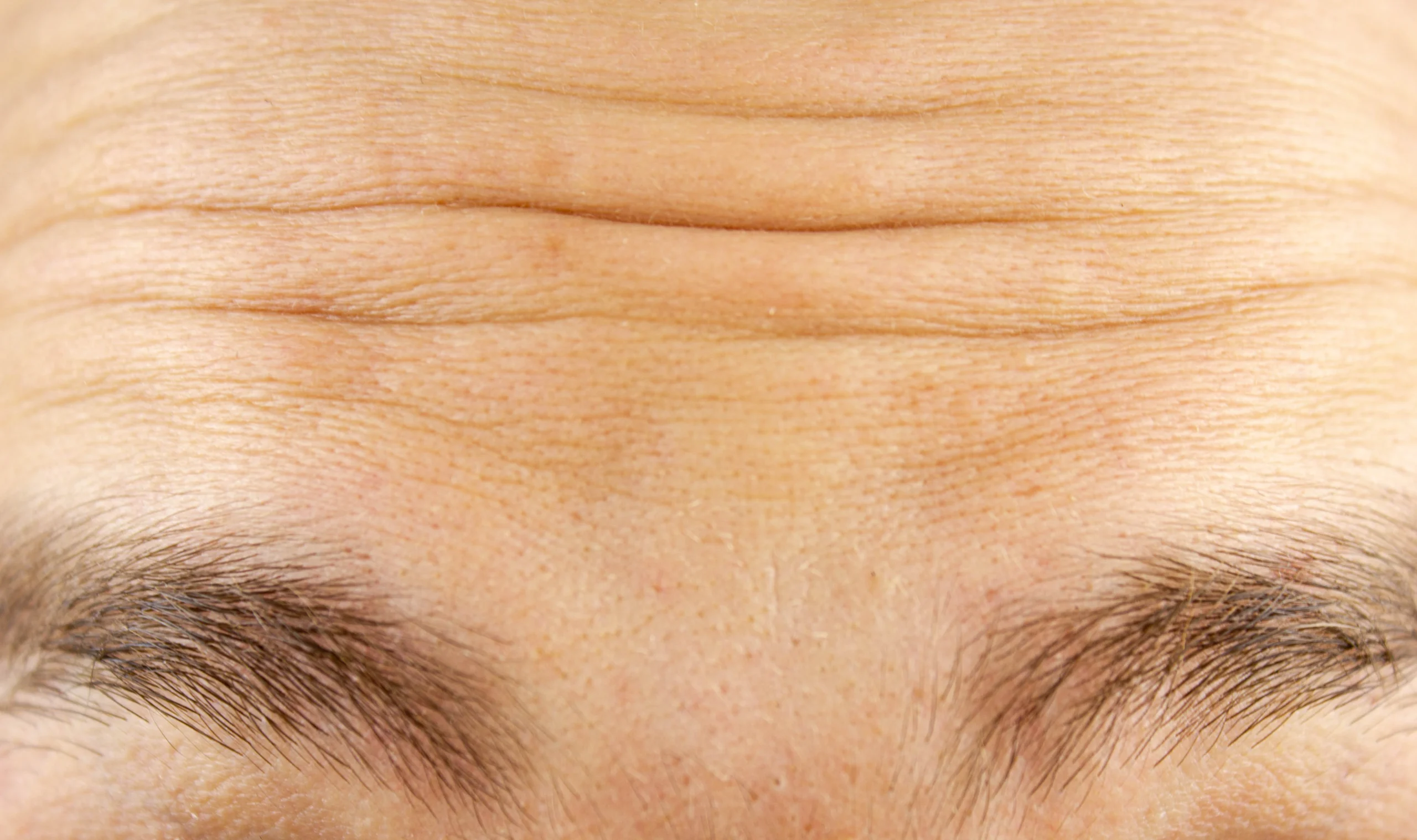 Forehead wrinkles
