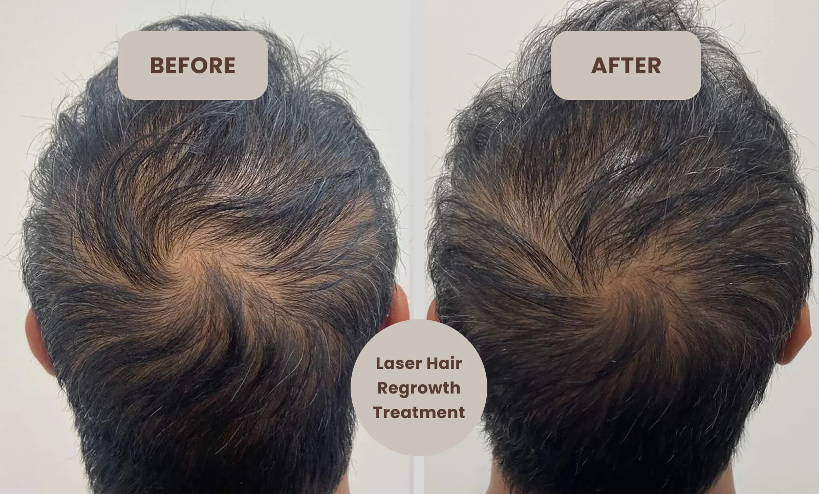 laser for hair loss before and after​