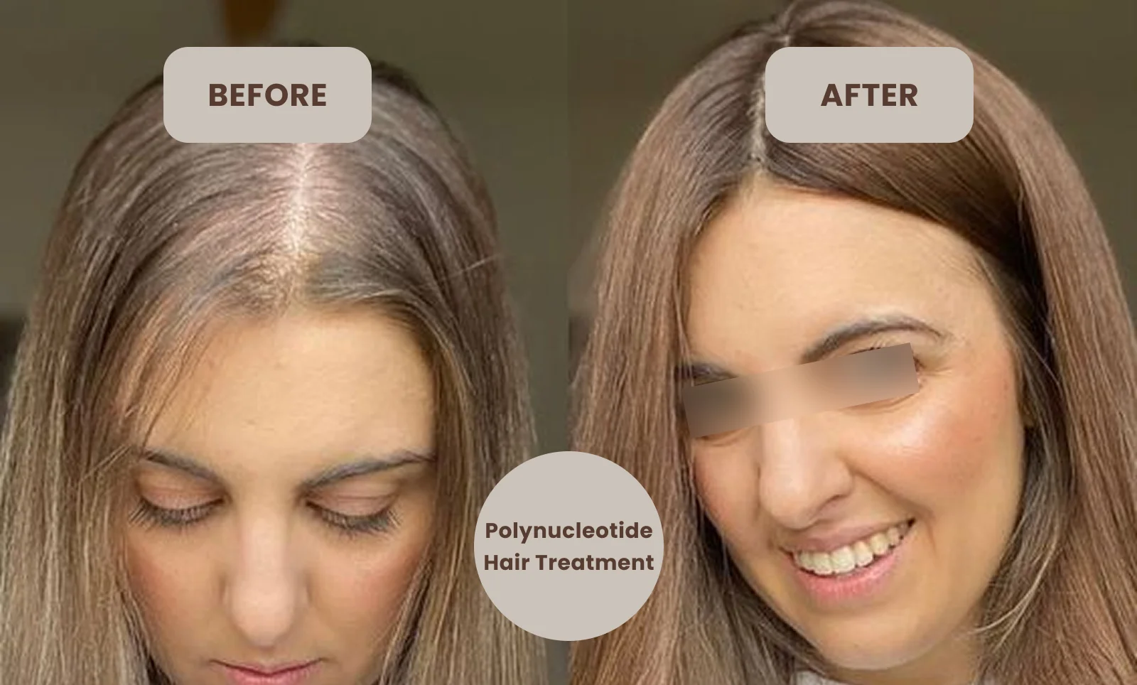 polynucleotide treatment for hair loss
