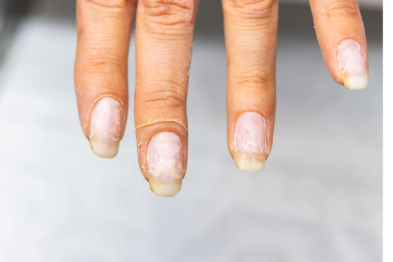 Brittle Nails