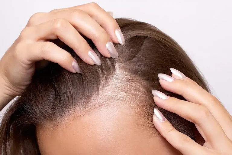 Hair Loss