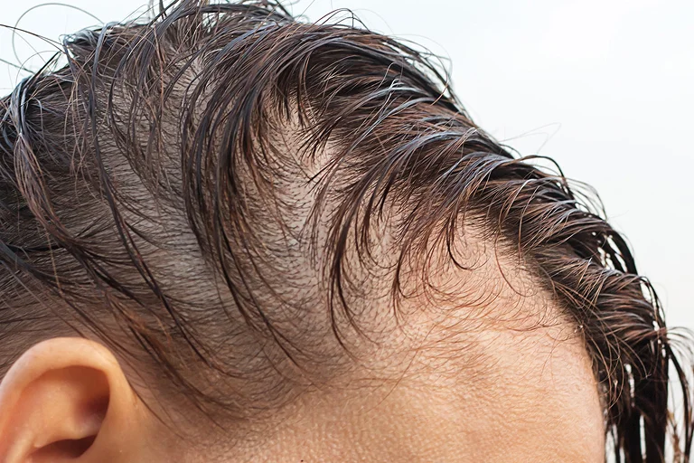 polynucleotides hair loss treatment
