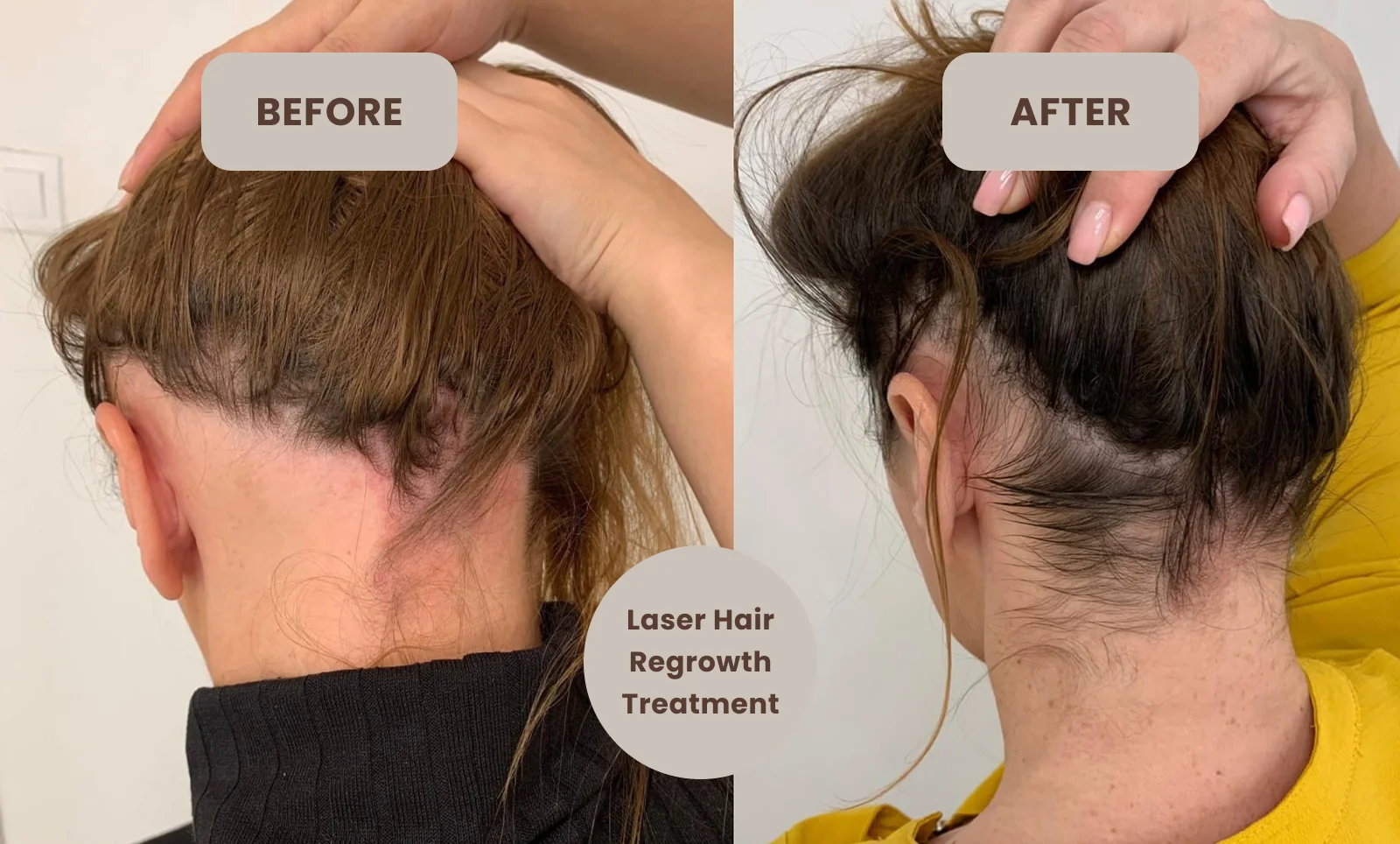 laser hair regrowth
