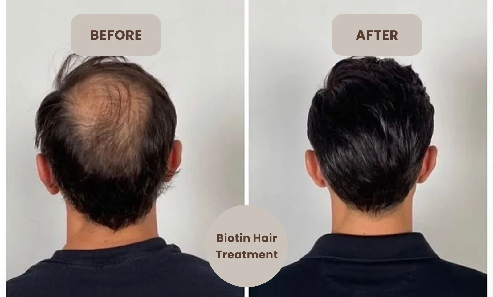 biotin treatment for hair