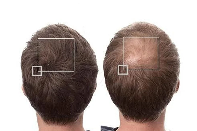 hair regrowth laser therapy