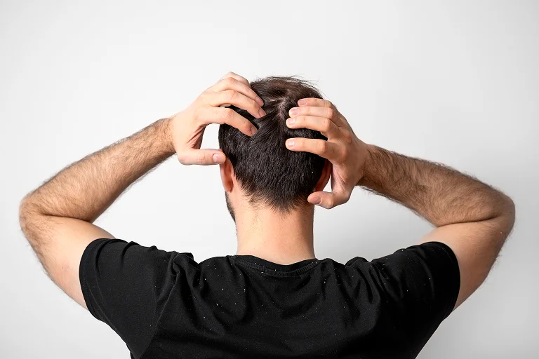 laser for hair loss​