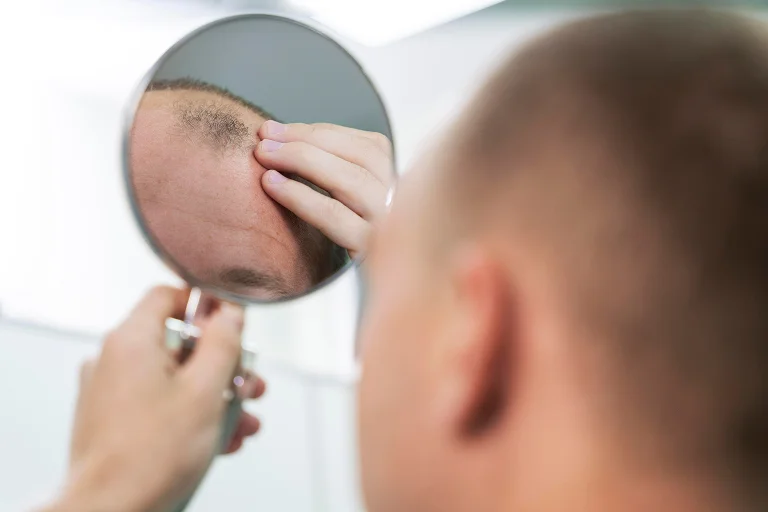 polynucleotides treatment for scalp inflammation
