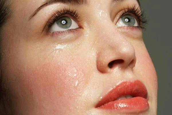 facial Hyperhydrosis
