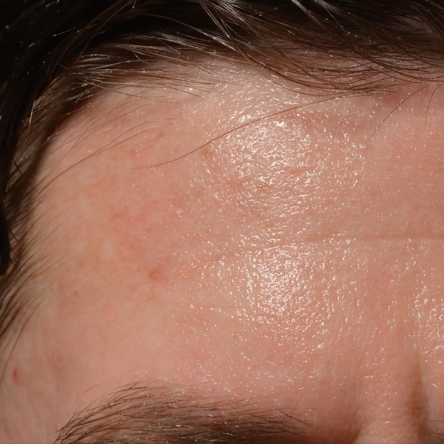 How to treat hyperhidrosis