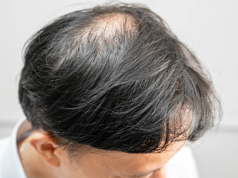 Hair Restoration Birmingham