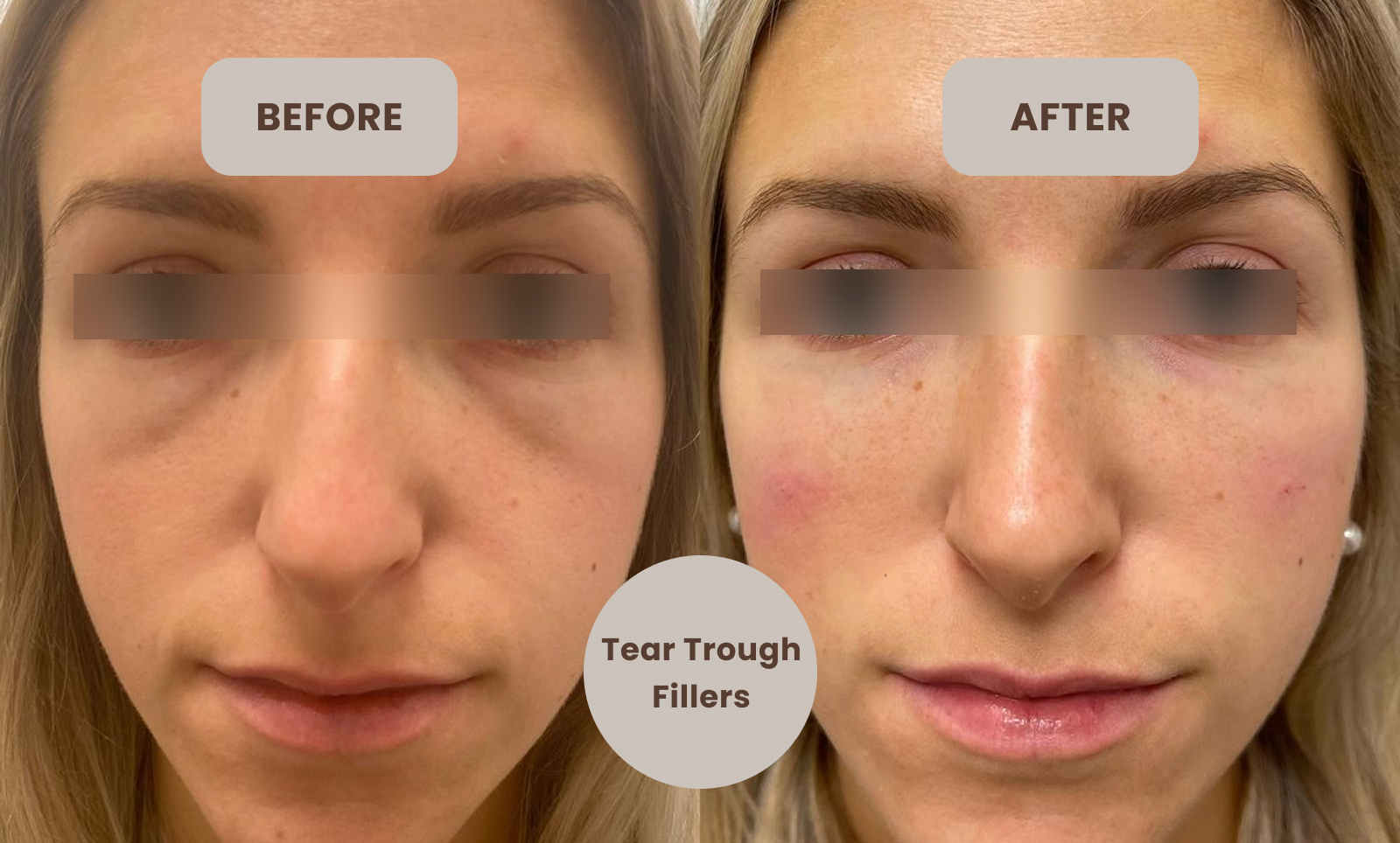 Tear trough filler before and After