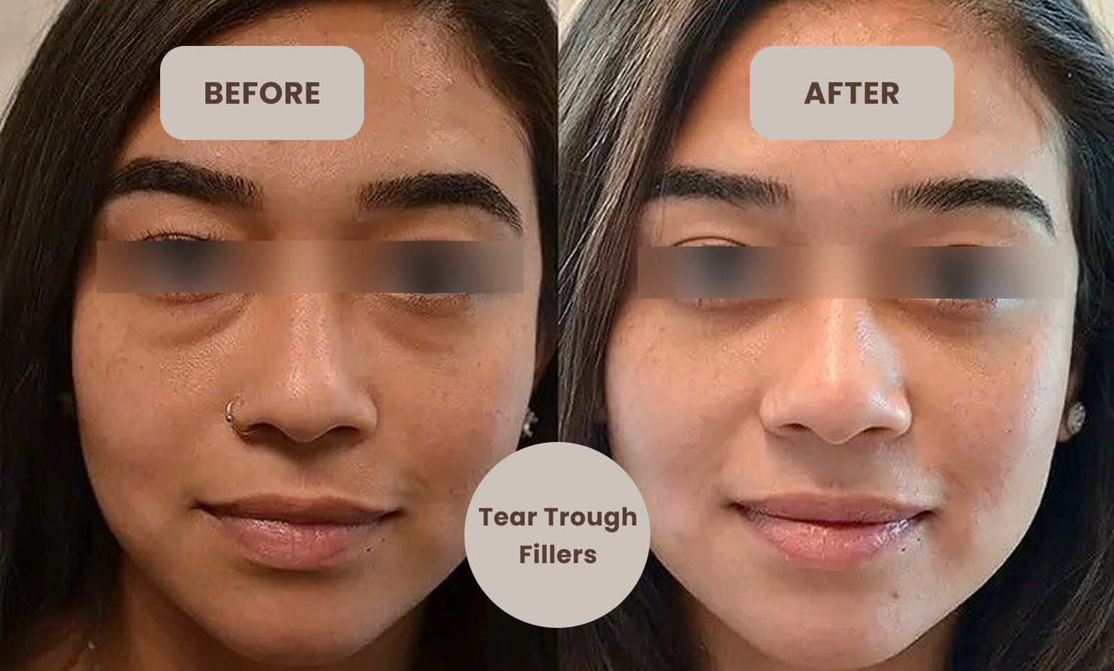 dermal fillers tear trough before after