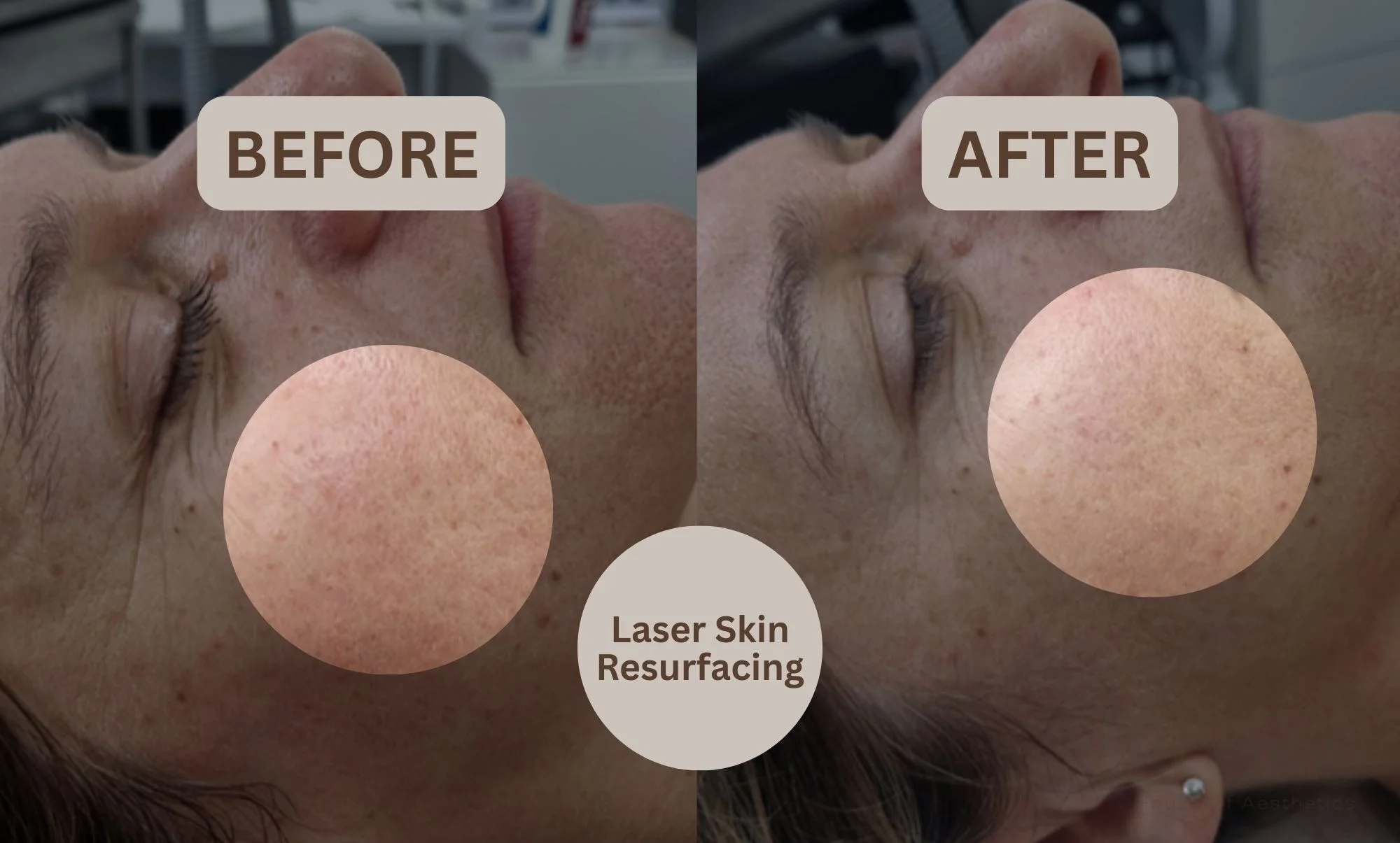 laser resurfacing