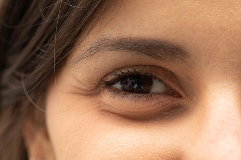 Eye Puffiness