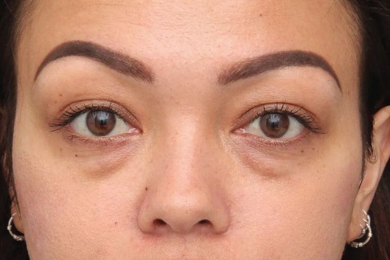 Tired Eyes