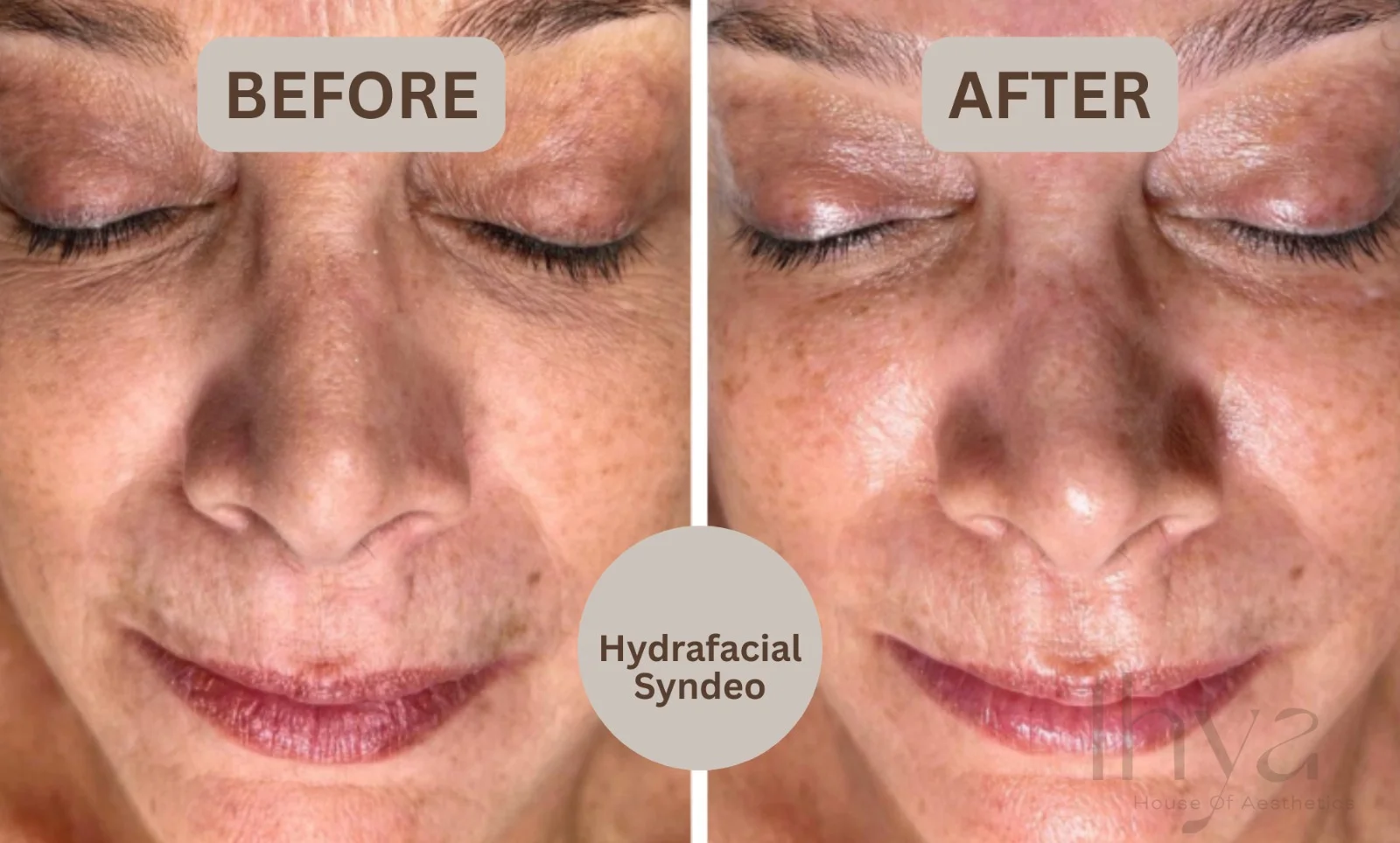 HydraFacial Syndeo® Face