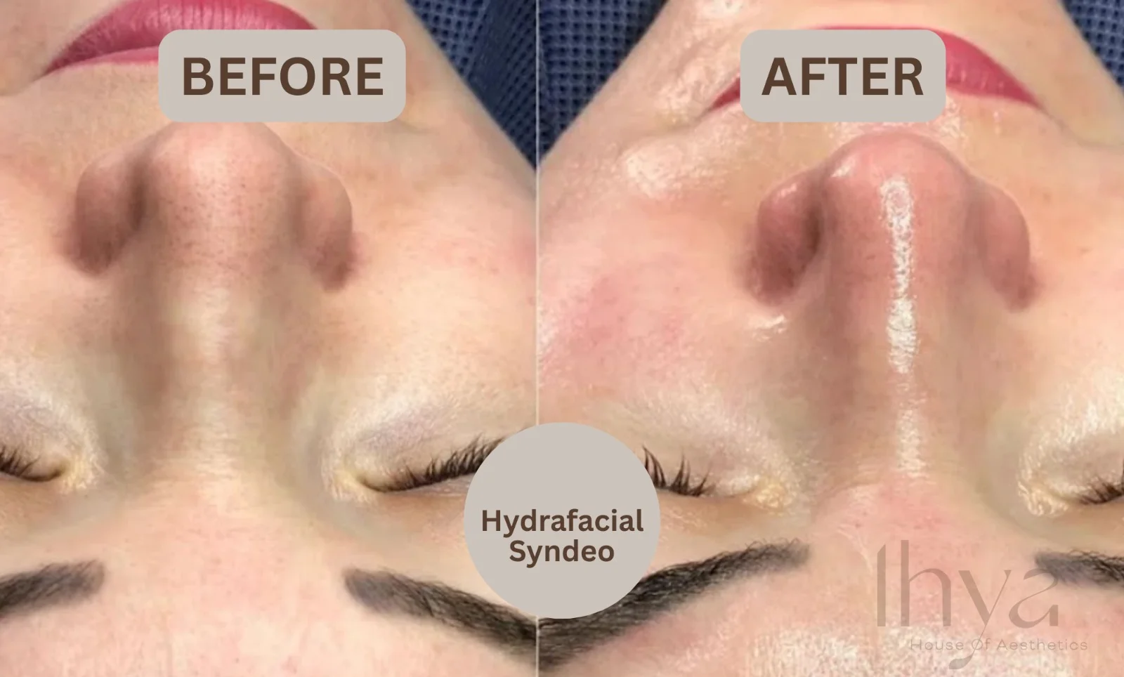 HydraFacial Syndeo® Face