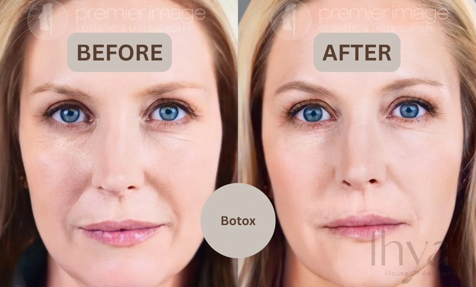 botox in birmingham