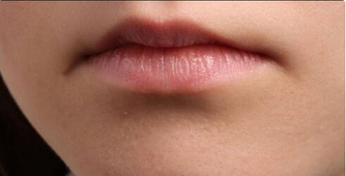 lip fillers birmingham UK