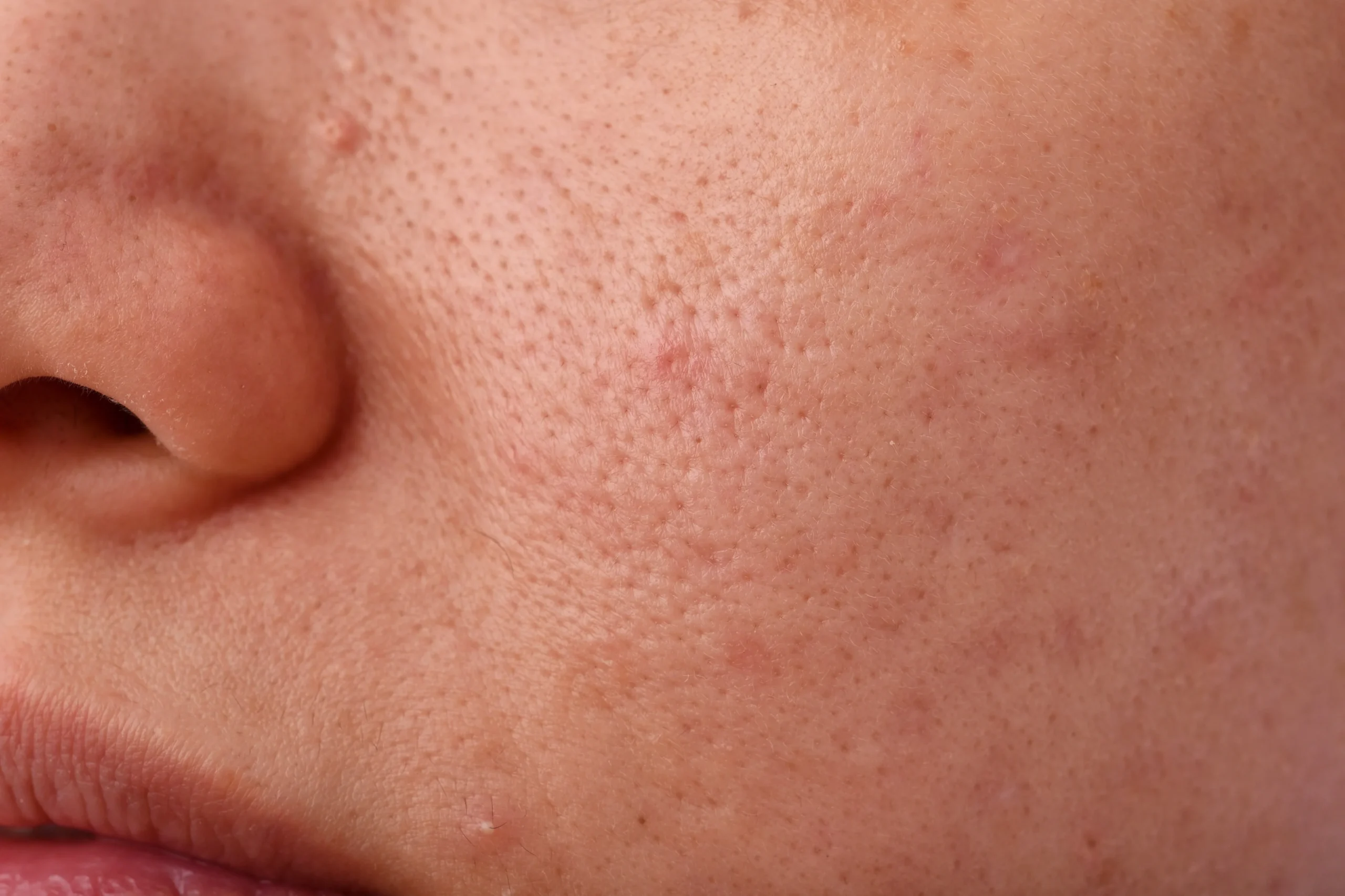 Pore enlargement