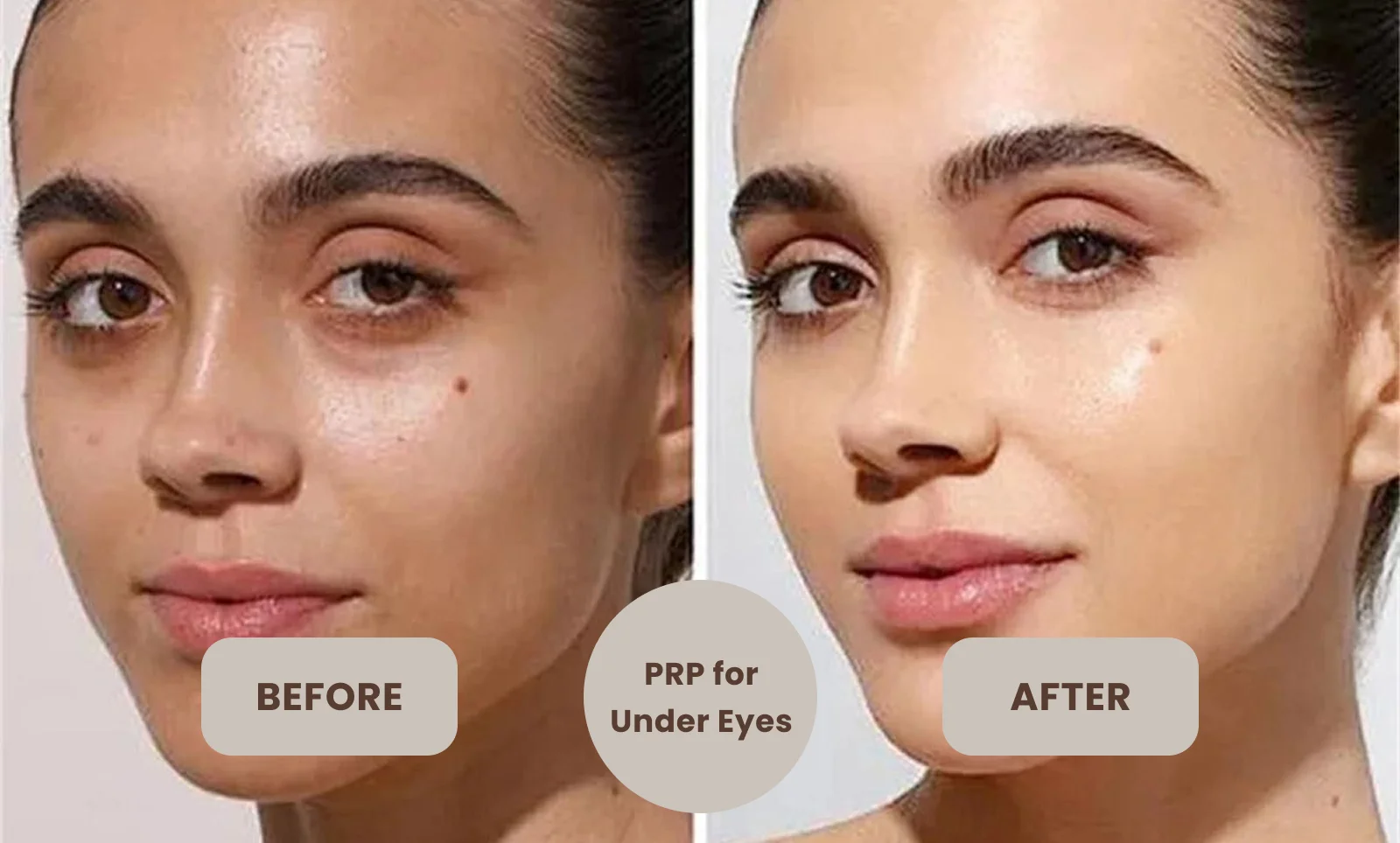 PRP Under Eye treatment Before and After Results