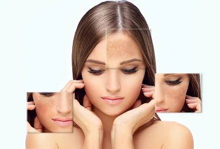 Discolouration or pigmented skin