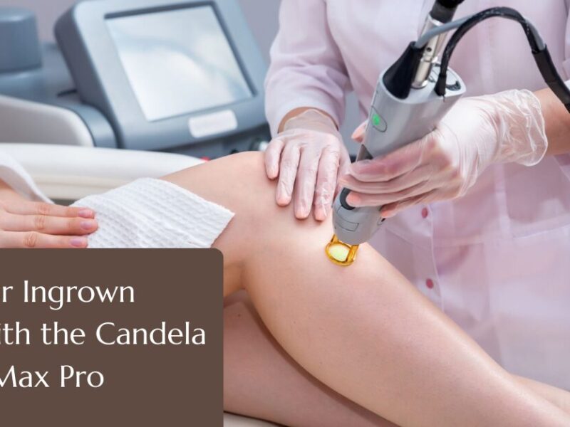 Laser for ingrown hair with Candela Gentlemax pro