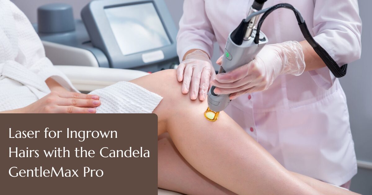Laser for ingrown hair with Candela Gentlemax pro