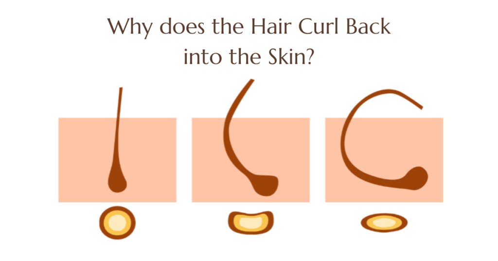 Hair curling back into skin